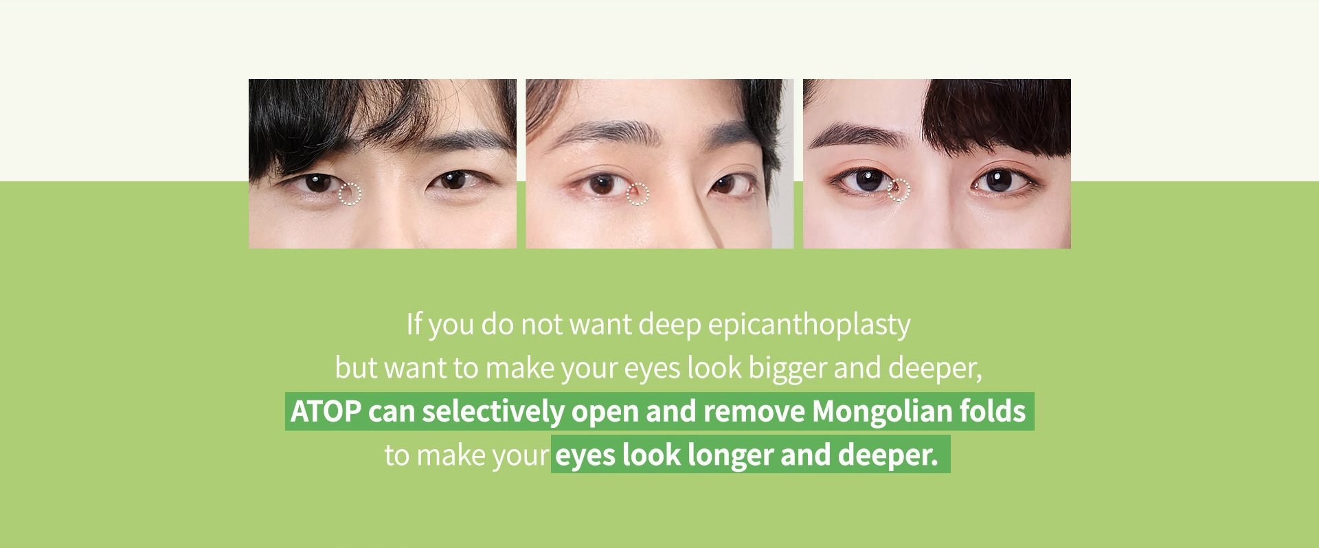 남자 트임성형